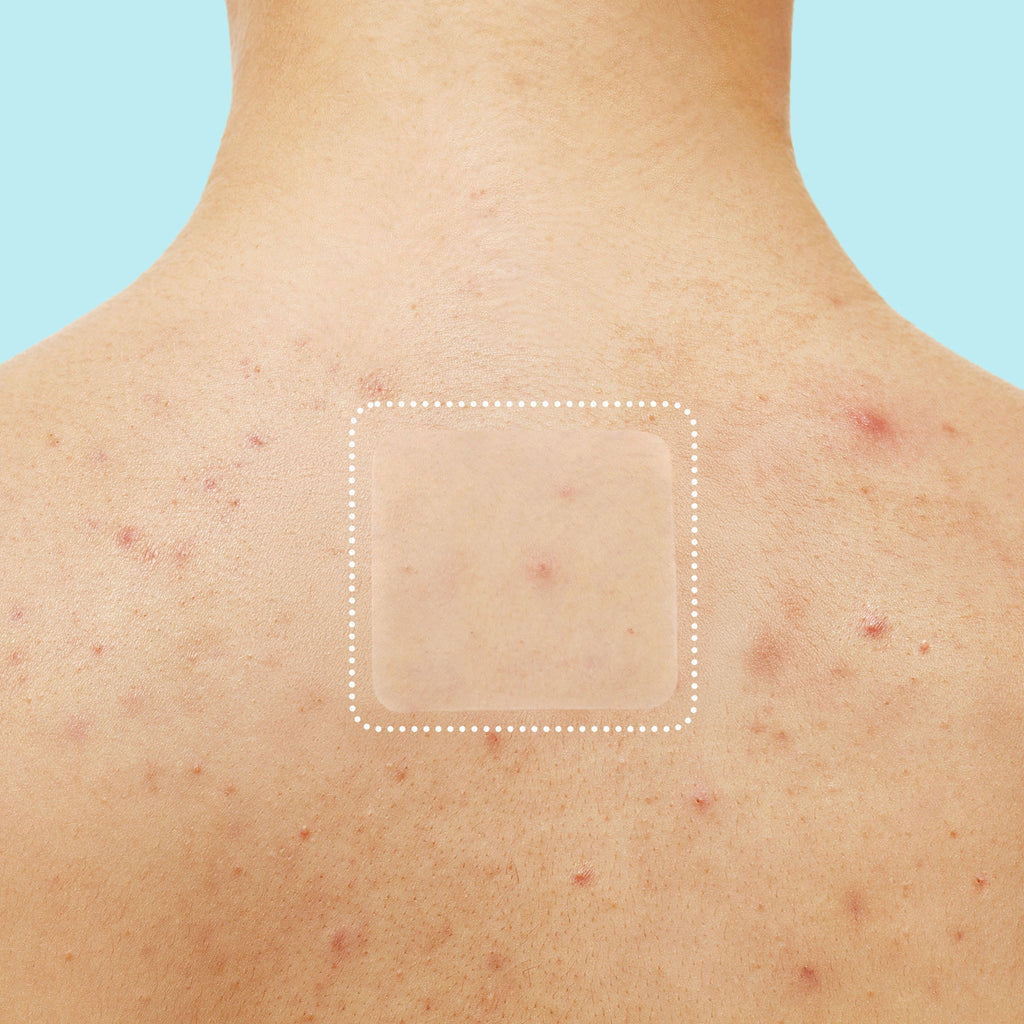 Miracle Patch XL Spot Control Cover Z2