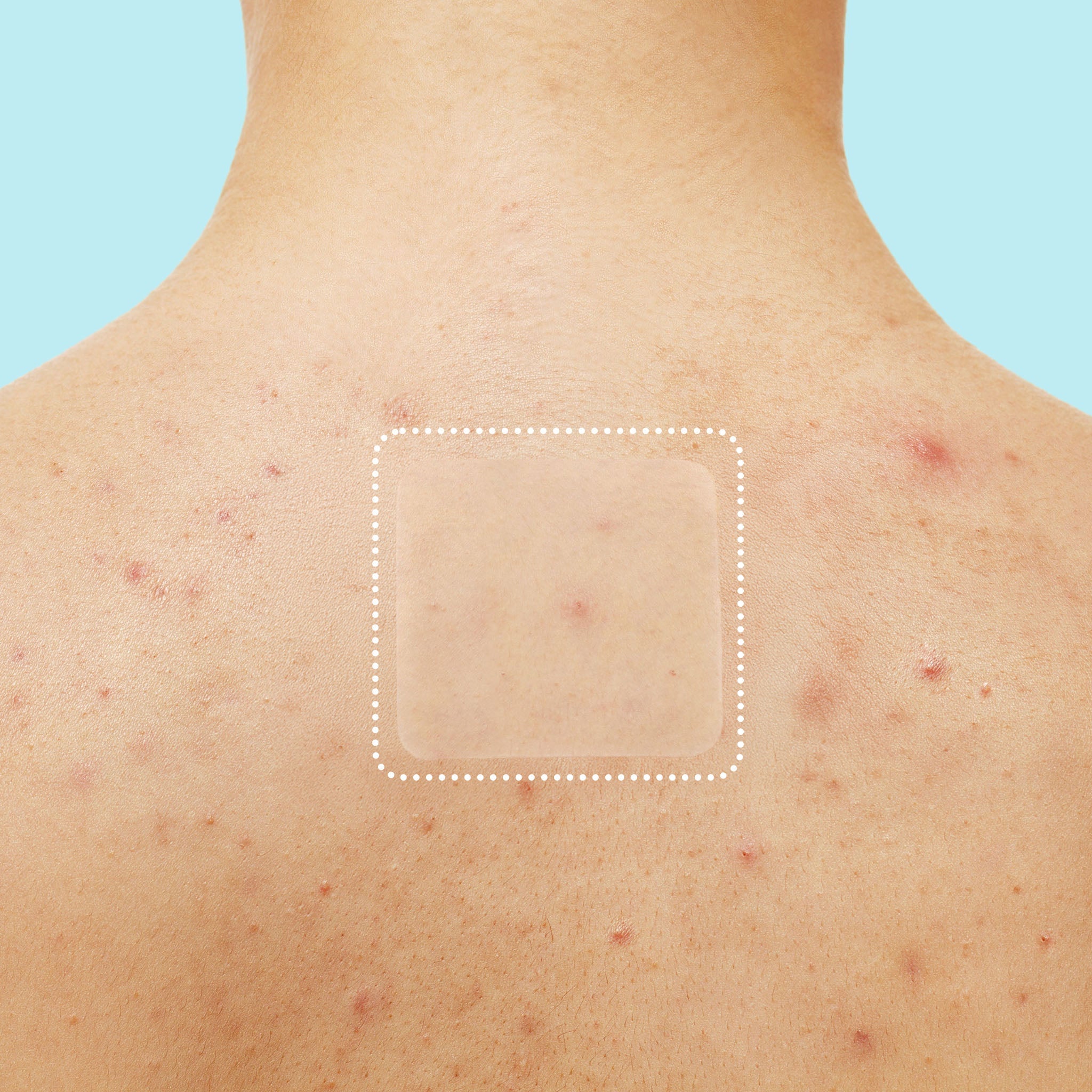 Miracle Patch XL Spot Control Cover Z2